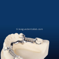 Dental cast bahagyang balangkas